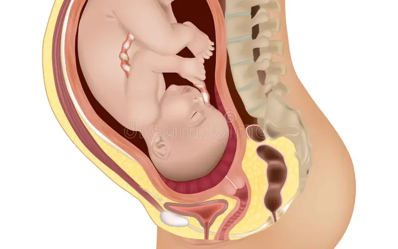 placenta previa, low lying placenta