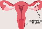 endometriosis meaning in urdu, what is endometriosis in urdu