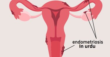 endometriosis meaning in urdu, what is endometriosis in urdu